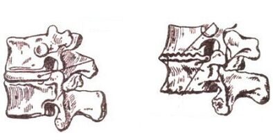 Stages of development of cervical osteochondrosis