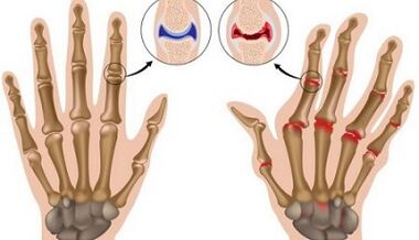 The main differences of arthritis and arthrosis