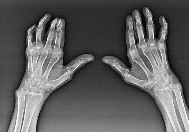 Diagnostics of the joints of the fingers