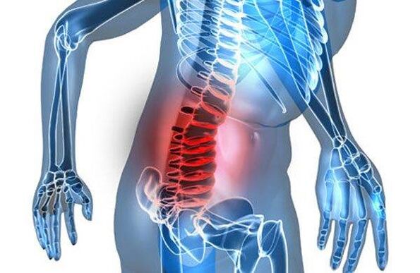 Spinal deformity at the fourth stage of lumbar osteochondrosis