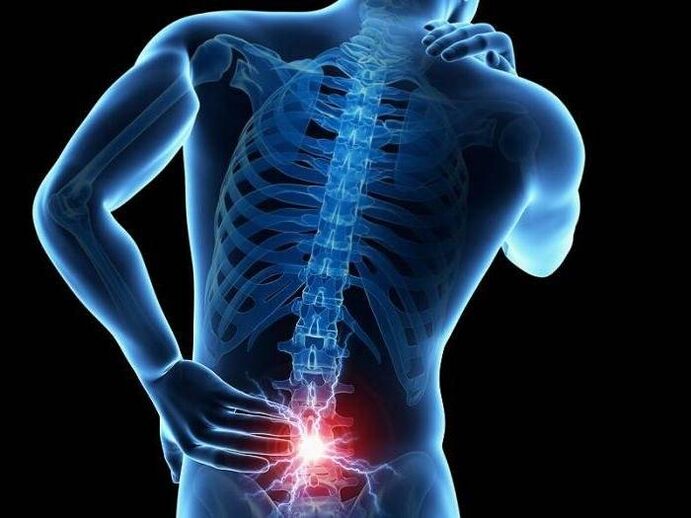 With radiculitis, pinched nerve roots provoke the appearance of sharp pain in the lower back