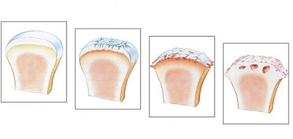 Healthy joint and 3 degrees of arthrosis development