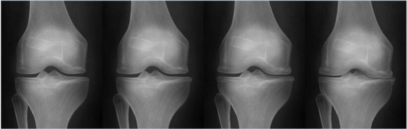 Stages of arthrosis according to the Kellgren-Lawrence classification